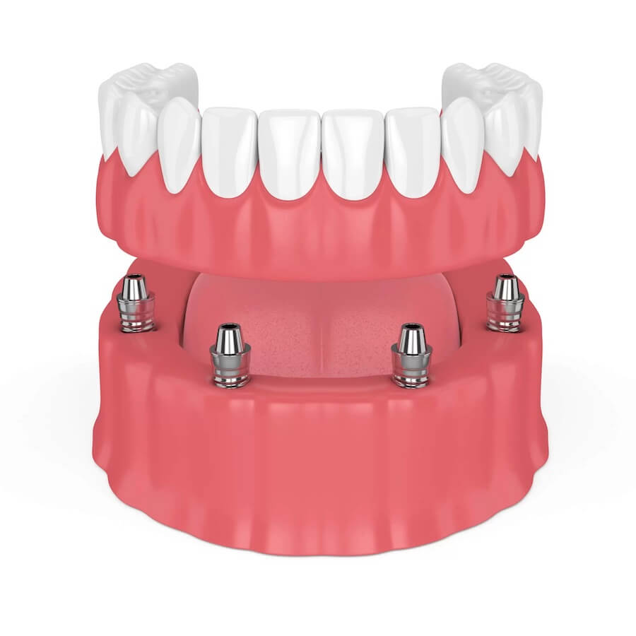 2 Main Types of Denture Implants