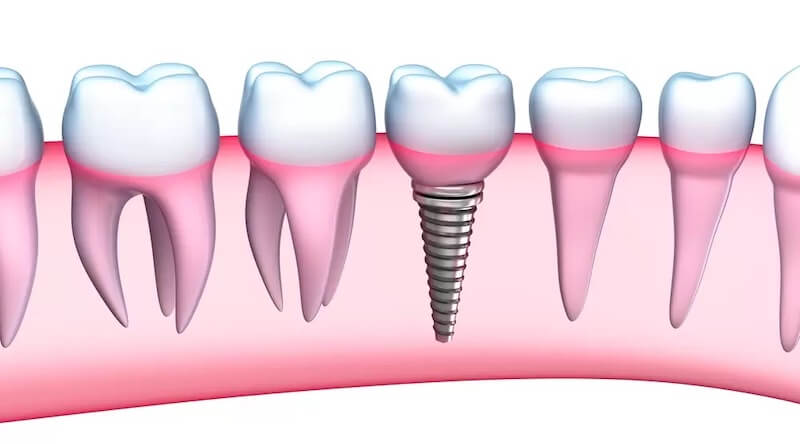 Caring for Your Dental Implant