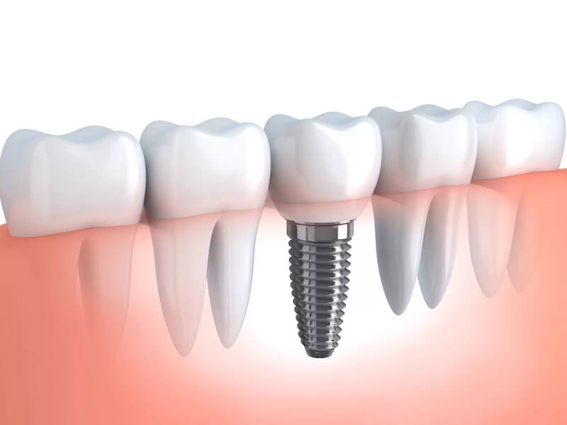 What You Shouldn’t Do After Dental Implant Surgery