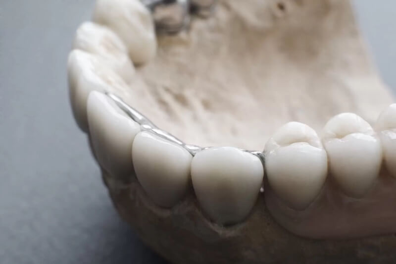 Can Ceramic Dental Implants Prevent Peri-Implantitis?