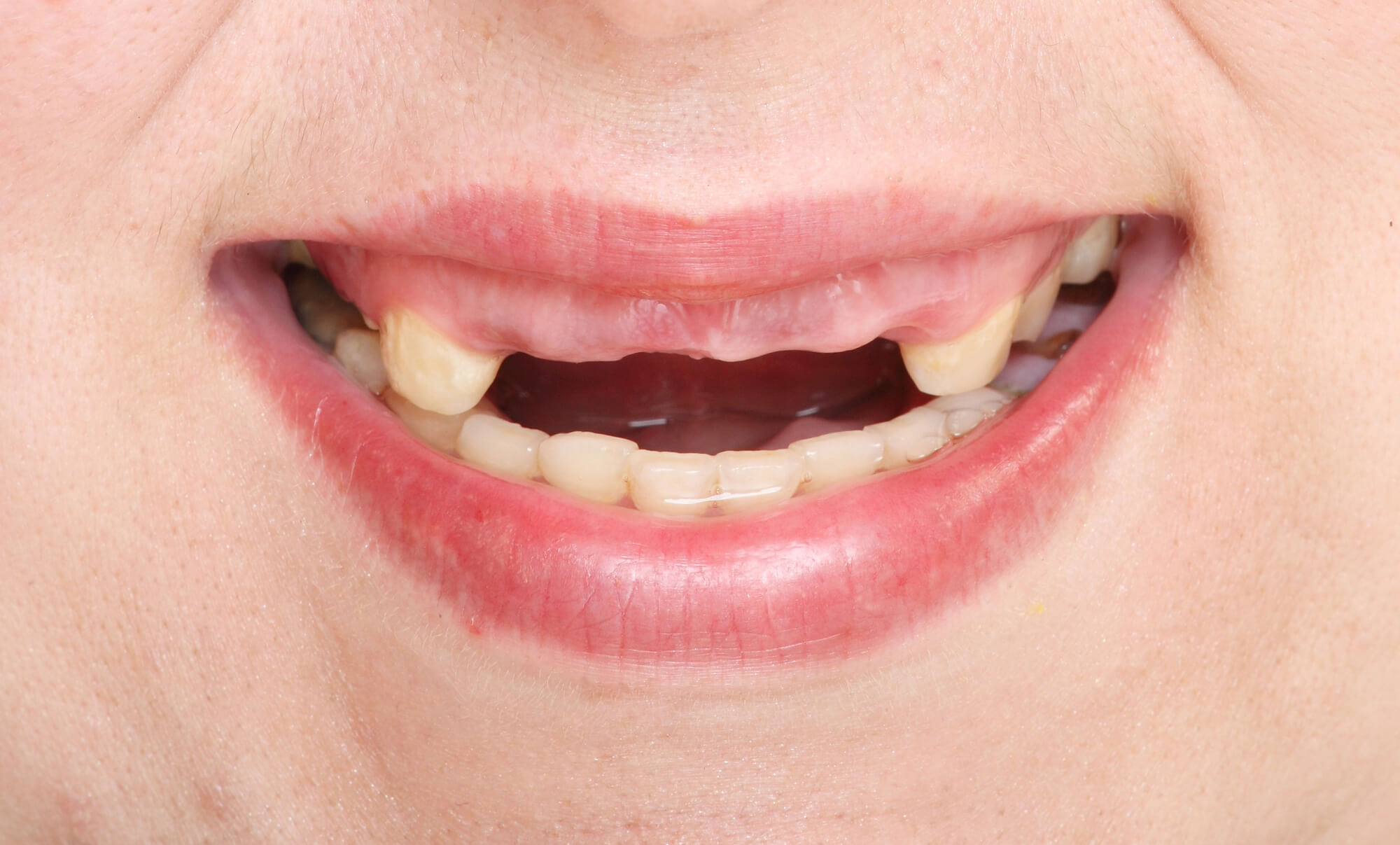 What Is the Full Impact of Missing Teeth?