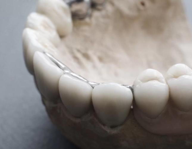 Can Ceramic Dental Implants Prevent Peri-Implantitis?