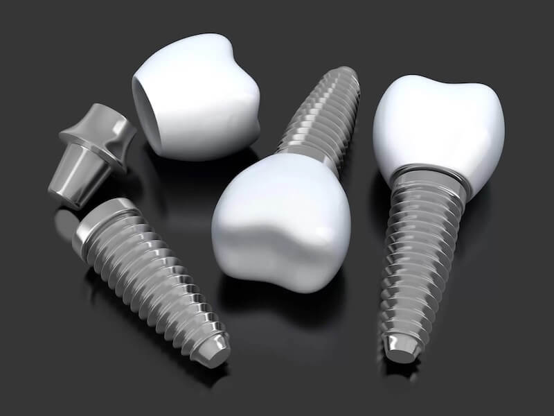 The Difference Between Dental Implants and Mini Implants