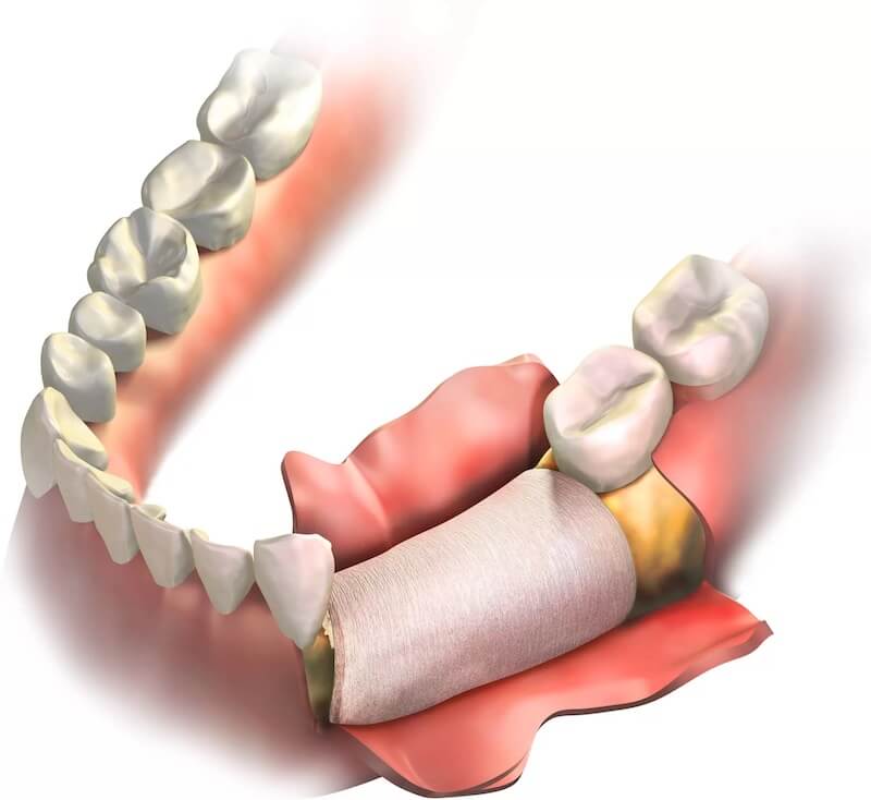 What Are the Benefits of Bone Grafting Procedures?