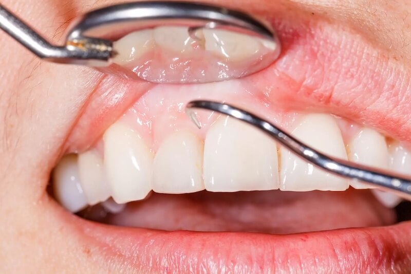 How Do Periodontists Treat Gum Disease?