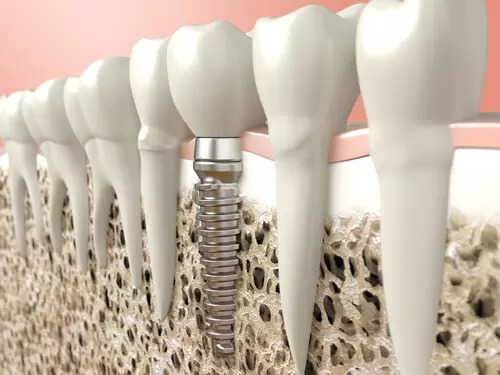 4 Facts About Dental Implants