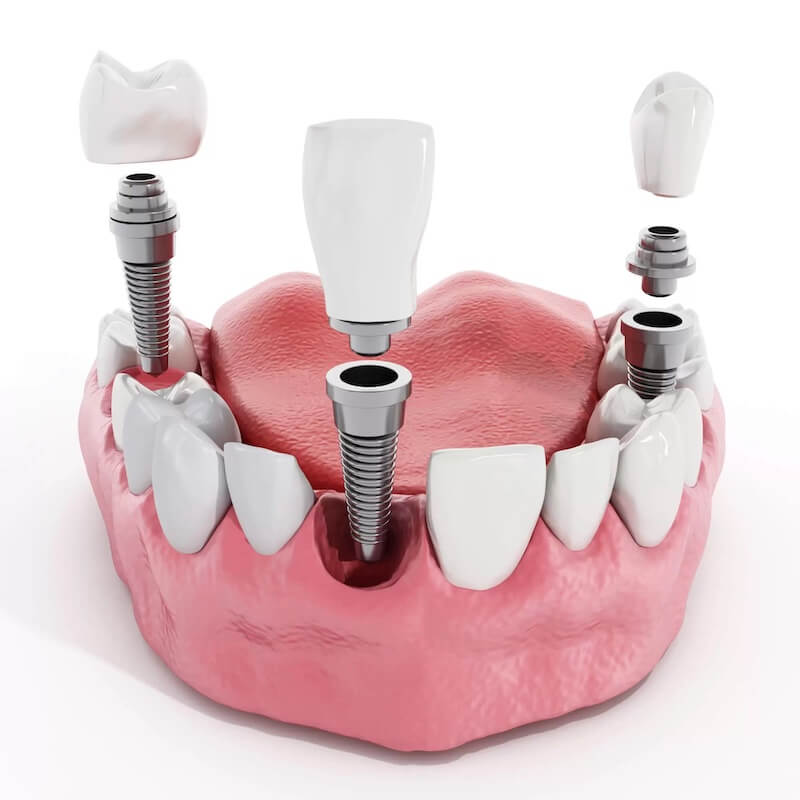 What Are the Components of a Dental Implant?