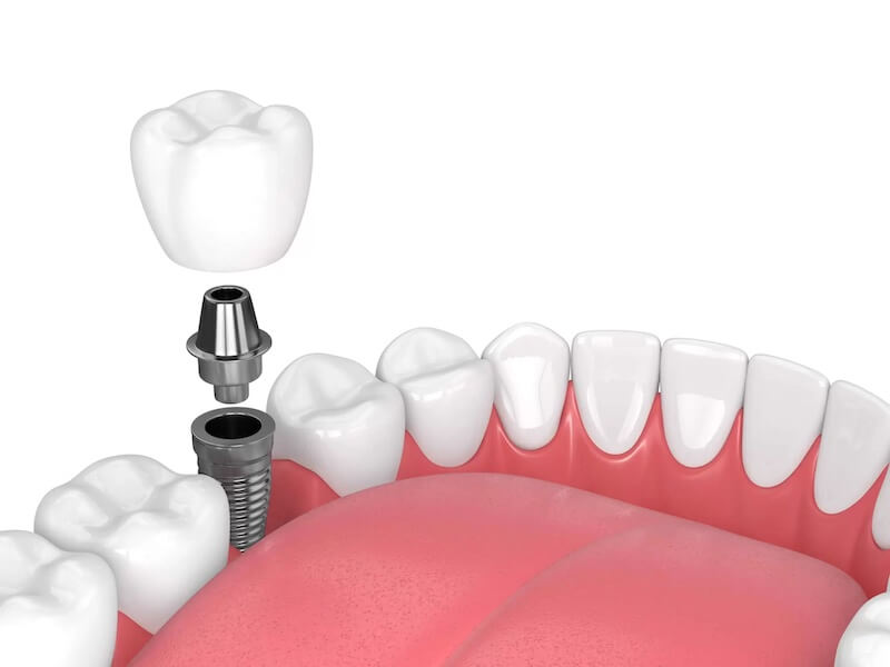 The Basics of Dental Implant Care